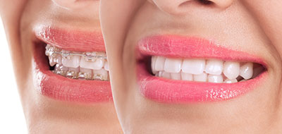 Dental braces in Cumming GA