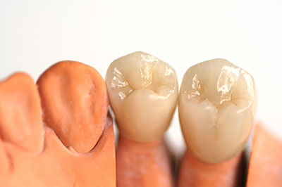 Cumming GA Dental Crowns