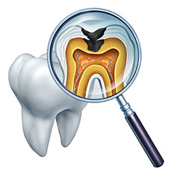 Tooth Decay in Cumming GA