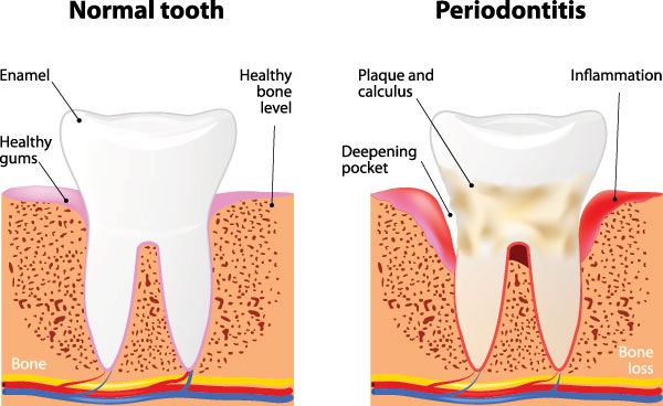 Periodontal Treatment Cumming GA