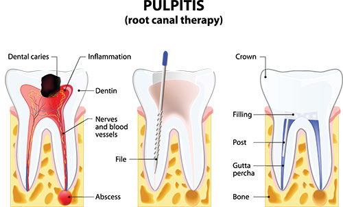 Root Canal Treatment in Cumming GA