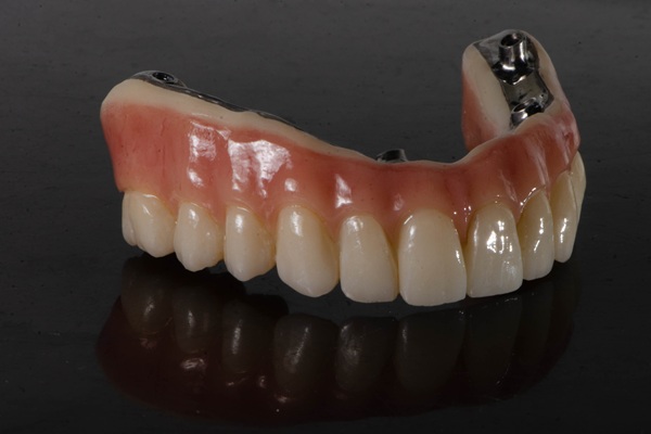 How Long Do All On   Implants Last?