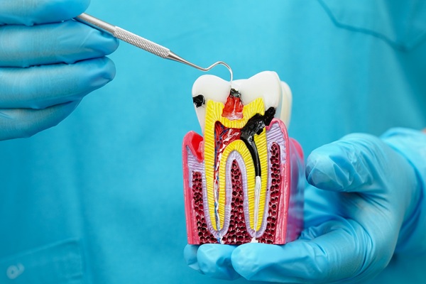 Root Canal Questions: What Is Tooth Pulp?